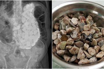 Batu dan kerikil di dalam perut pasien