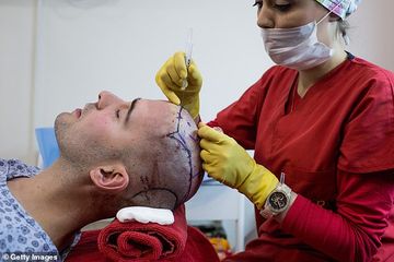 Mengatasi Rambut Rontok, Seperti Ini Jika Memilih Transplantasi dan Efek Sampingnya