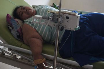 Sunarti kini telah tiada. Tubuhnya menjadi gemuk karena salah mengonsumsi obat steroid.