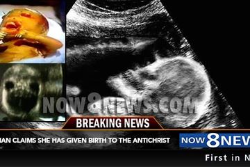 Bayi Setan, Bertahan Hidup Tanpa Air Ketuban dan Plasenta Robek Hingga Dilahirkan