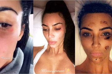 Kim Kardashian Ternyata Penderita Psoriasis di Wajah! Skin Tightening Solusinya Supaya Bisa Tampil Sempurna