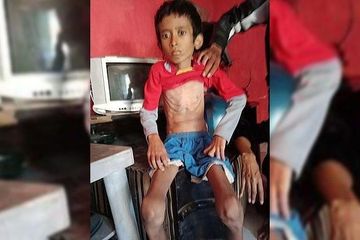 Fajar Saefudin meninggal dunia akibat menderita TBC, kenali penyebabnya