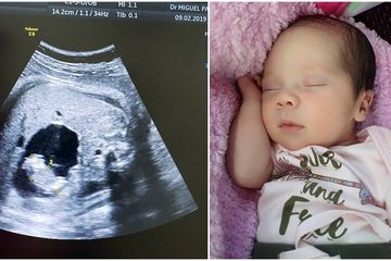 Terjadi Lagi Bayi Baru Lahir Ini Mengandung Janin Kembarannya Sendiri Sejak Dalam Kandungan Semua Halaman Grid Health