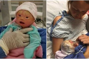 Bayi kecil ini alami kelainan penyakit yang membuatnya berisiko meninggal saat disentuh