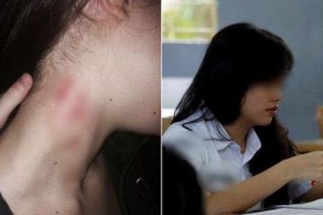 Bukan rasa malu yang menjadi masalah dari kecupan di leher yang sebabkan cupang, tapi bisa menbuat stroke dan kematian.