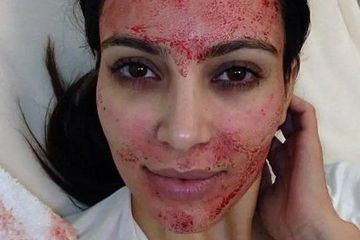 Tergoda Perawatan Vampire Ala Kim Kardashian, Dua Wanita Malah Kena HIV