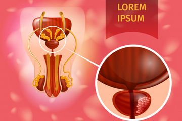 Suplemen Vitamin D Bisa  Memperlambat Kanker Prostat, Begini Faktanya