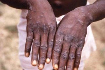 Penularan infeksi cacar monyet ke manusia. Waspadai gejalanya.