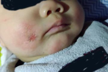 Curhat orangtua sepulang dari pesta karen anaknya sakit dermatitis atopik, direspon lebay warganet