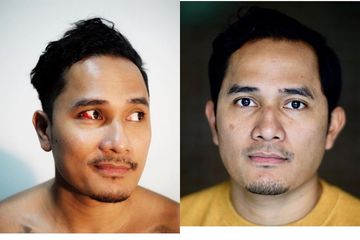 Stress Dan Kebanyakan Main Handphone Pembuluh Darah Mata Tanta Ginting Pecah