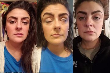 Shayna Aldrich alami bell's palsy