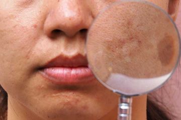 Atasi melasma atau bercak kecokelatan di wajah ibu hamil dengan 5 bahan alami