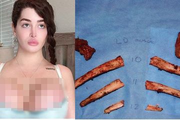 Dendam Diejek di Kampus Sampai Rela Mati Untuk Operasi Plastik, Tega Potong Tulang Rusuk