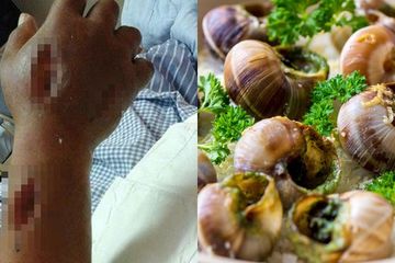 Waduh, Setelah Makan Seafood Sisa Semalam Masuk Rumah Sakit, Gegara Udang Tangannya Melepuh