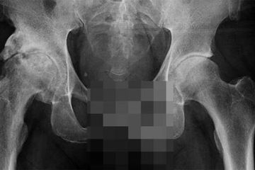Update Covid-19; Virus Corona Bisa Sebabkan Kerusakan Alat Vital Pria!