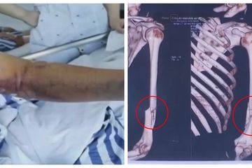 Adu Panco Sama Temen Kampus, Cowok Ini Alami Patah Lengan di Dua ...