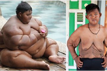 Dulu Miliki Bobot Capai 192 Kg, Begini Tampilan Aria Permana Setelah Jalani Serangkaian Operasi Hingga Hilangkan Gelambir