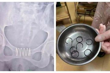 Dipikirnya Kontrasepsi Spiral Sama dengan Per, Ibu ini Benamkan Pegas Besi ke Dalam Kemaluanya
