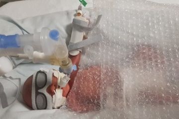 Kondisi Haris, bayi prematur yang dibungkus plastik gelembung untuk menjaga tubuhnya tetap hangat.  