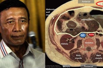 Breaking News Wiranto: 2 Luka Tusuk Pada Tubuhnya Mencapai Lapisan Peritoneum Berisiko Picu Peritonitis
