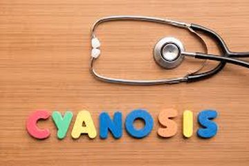Munculnya kebiru-biruan di tubuh, bisa terjadi akibat sianosis yang perlu segera mendapat pertolongan.