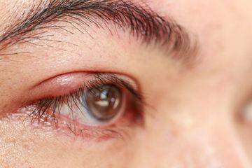 Dakrioadenitis merupakan peradangan di kelenjar air mata.
