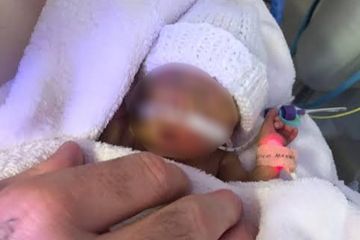 Lahir dengan Berat 0,7 Kg, Bayi Terkecil Ini Divonis Tak Dapat Bertahan Hidup