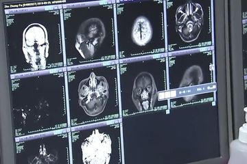 Setelahj makan steamboat daging babi pria ini mengalami penyakit epilepsi