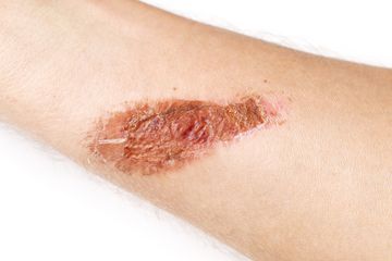 Hati-hati, terapi jeruk nipis ternyta bisa berisiko membuat kulit terbakar.