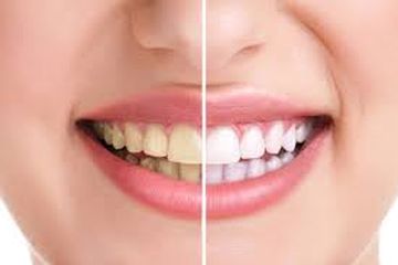 5 tips untuk mencegah dan menyingkirkan plak pada gigi dengan efektif.