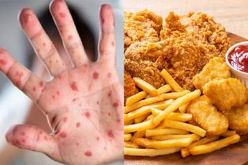 Makanan Penyebab Rubella Hindari Anak Pada Jenis Makanan Ini Jika Tidak Ingin Tertular Virusnya Semua Halaman Sajian Sedap