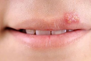 Cold sore atau luka dingin tampak pada bibir disebabkan oleh virus herpes simpleks.