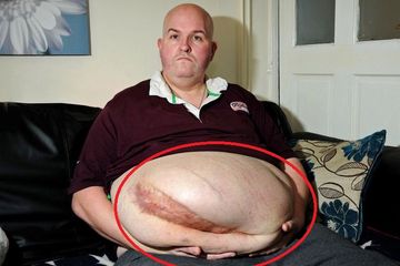 Dean Carron dengan hernia terbesar di dunia yang dimilikinya.
