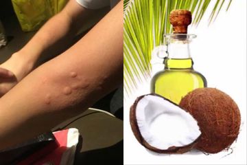Bila Dirasa Biduran Tak Kunjung Sembuh Ini Obat Biduran Herbal Yang Bisa Dicoba Di Rumah Salah Satunya Minyak Kelapa Semua Halaman Intisari