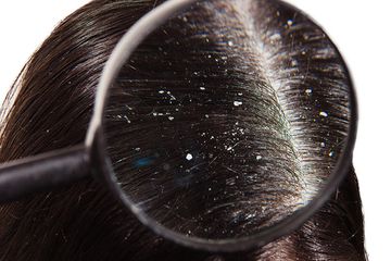 14 Hari Rambut Bebas Ketombe Dan Rontok Day 1 Penyebab Kemunculan Ketombe Semua Halaman Stylo 14 Hari Rambut Bebas Ketombe Dan Rontok Day 1 Penyebab Kemunculan Ketombe Semua Halaman Stylo