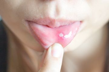 4 Obat Alami Ini Ampuh Atasi Sariawan yang Terasa Nyeri dan Mengganggu