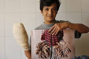 Manusia Pohon Ini Ingin Tangannya Diamputasi, Tak Kuat Lagi Menahan Sakit yang Dirasa