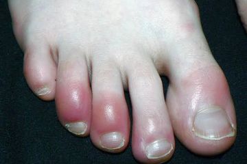 Covid-Toes, Gejala Baru Covid-19 Pada Kaki dengan Ciri Ruam Kemerahan