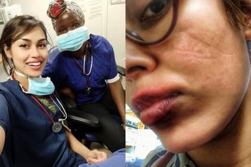 Miss England 2019 Bhasha Mukerjee yang juga dokter memamerkan wajahnya yang tertutup masker berjam-jam demi menolong pasien Covid-19 di Inggris