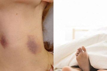 Dapati Leher Anaknya Merah Darah Penuh Bekas Ciuman, Ibu Ini Syok ...