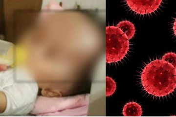 Cerita pilu seorang ayah yang jadi pengangguran semenjak pandemi Covid-19 dan harus berjuang mengobati sang anak yang menderita penyakit hidrosefalus.