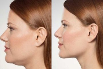 Hilangkan Double Chin  dengan mudah dan alami tanpa tindakan medis.