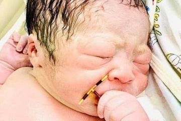 Seorang bayi yang lahir di Vietnam lahir dengan membawa IUD milik ibunya.