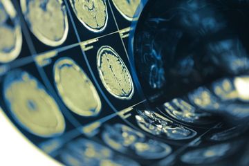  Infeksi Covid-19 Bisa Sebabkan Stroke dan Serang Otak, Tak Lagi Hanya  Pneumonia yang Selama Ini Dikhawatirkan