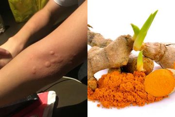 Sering Salah Seperti Ini Obat Biduran Alami Untuk Anak Anak Semua Halaman Intisari