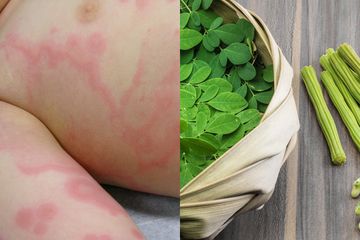 Coba Obati Biduran Dengan Antihistamin Alami Termasuk Daun Kelor Semua Halaman Intisari