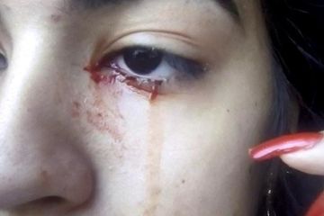 Seorang Remaja 15 Tahun Menangis Darah, Dokter Bingung, Dugaan Sementara Idap Haemolacria