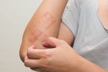 Rush atau ruam pada kulit sering muncul pada penyandang diabetes.