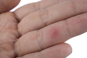 Jika serpihan tajam masuk ke kulit ini yang harus dilakukan. Jangan dicungkil, berisiko infeksi.
