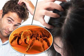 6 Tanda Ketika Memiliki Kutu Rambut Di Antaranya Sering Garuk Kepala Semua Halaman Grid Health